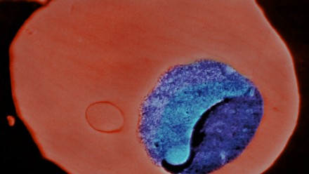 Scanning electron microscope image of a malaria parasite-infected human erythrocyte